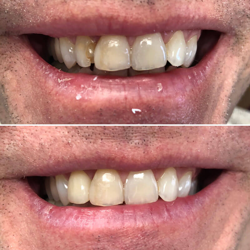 Before and After