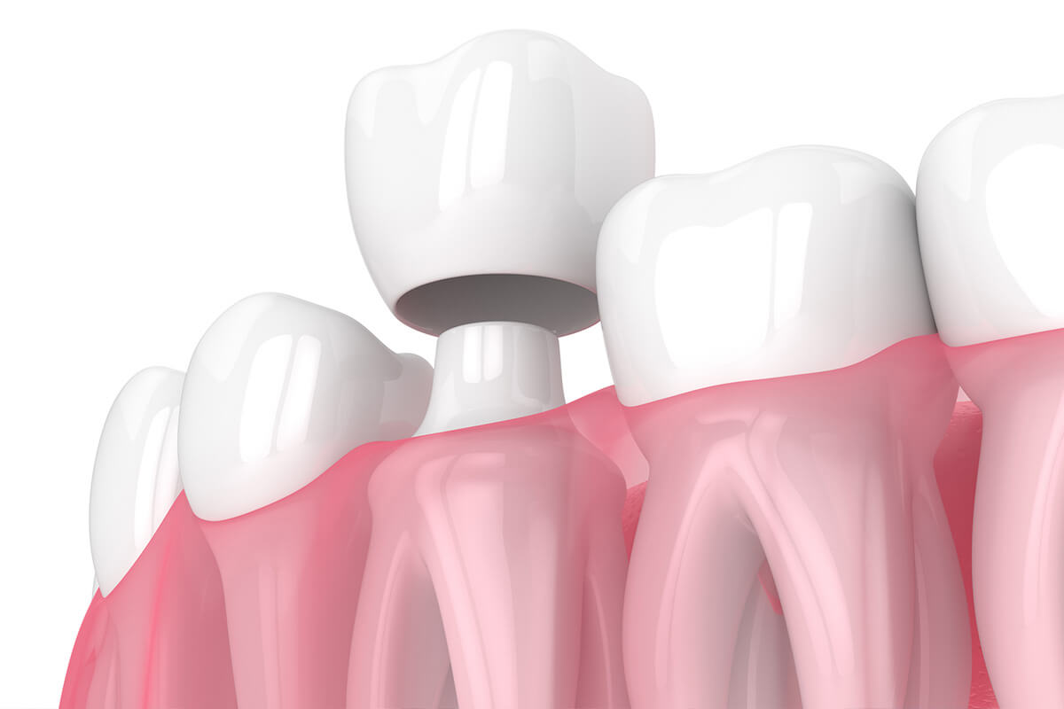 How Much Tooth Structure is Needed for a Crown