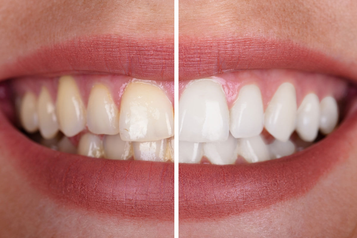 comparison of teeth before and after teeth whitening