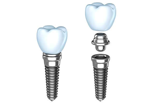 Single Dental Implants in Passaic County