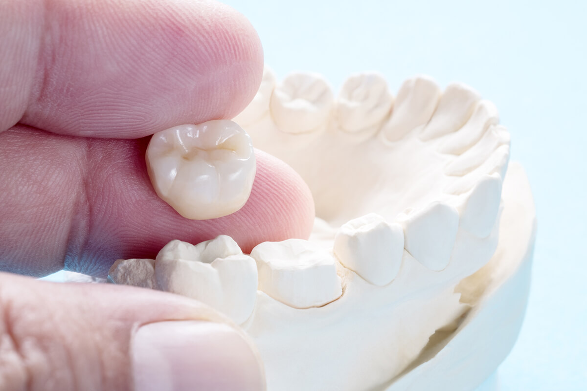 How Long Do Dental Crowns Last?