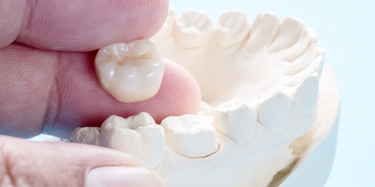 Dental Crowns in West Milford, NJ