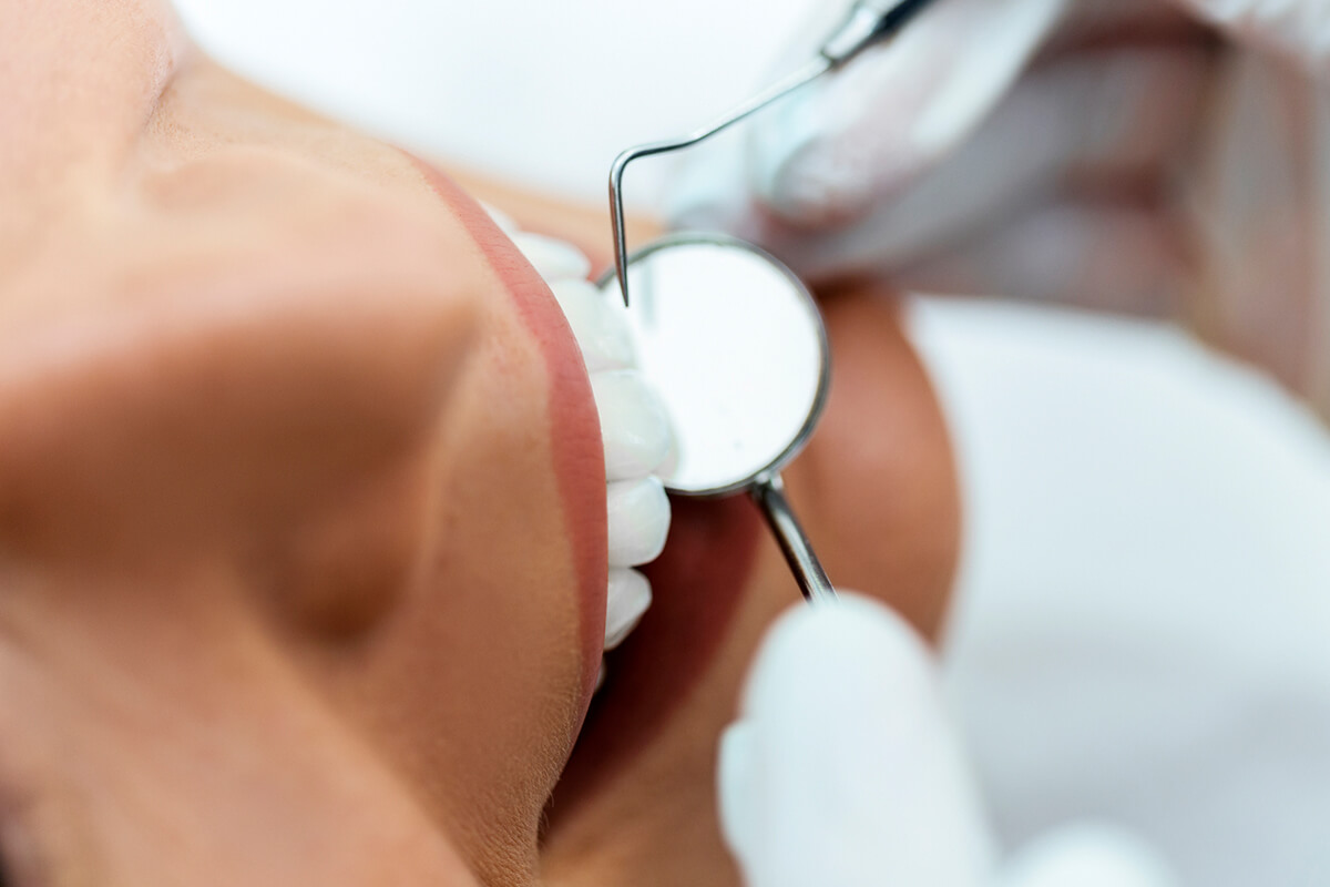 Porcelain Veneers vs. Composite Veneers: Understanding the Differences